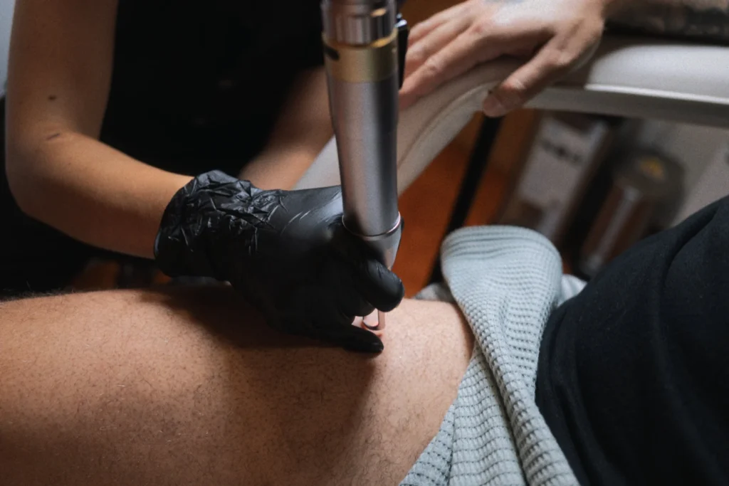 Especialista aplicando tecnología láser sobre la piel de un paciente para la eliminación de un tatuaje