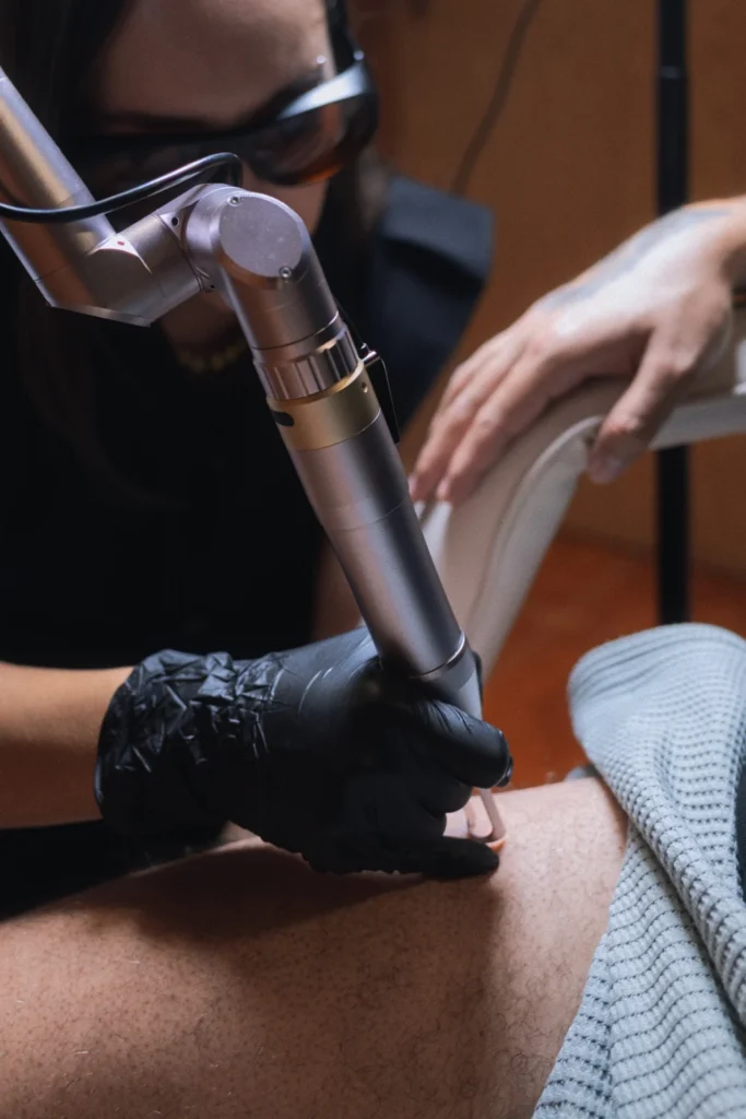 Primer plano de una especialista aplicando el equipo láser sobre la piel durante una sesión de eliminación de tatuaje