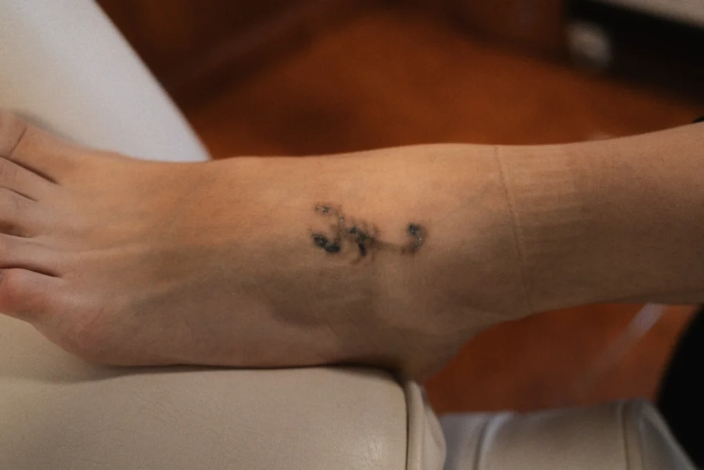 Detalle de un tatuaje en proceso de eliminación con láser en la zona del pie